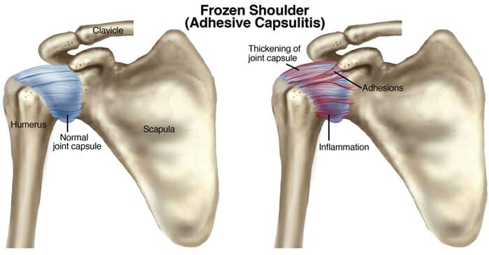 آناتومی مفصل شانه یخ زده/ درد شانه/ frozen shoulder/ شانه درد/ گرفتگی شانه