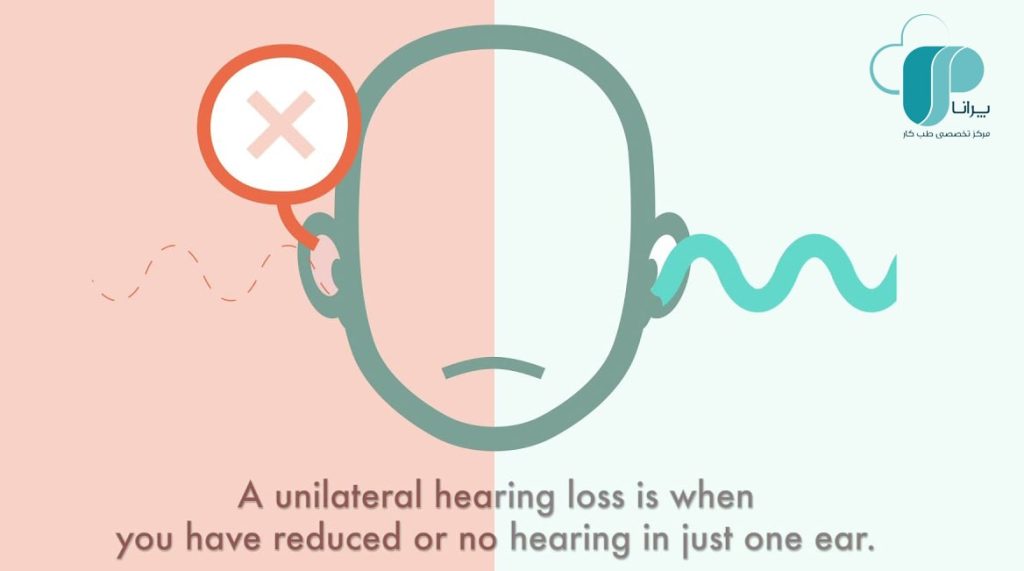 کم شنوایی یکطرفه/ تست شنوایی/ کاهش شنوایی/ اختلال جهت‌یابی/ادیومتری