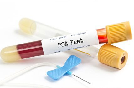 آزمایش PSA برای تشخیص سرطان پروستات در معاینات بدو استخدام و دوره ای طب کار
