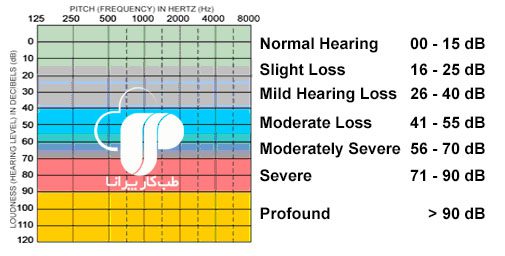 انواع نوار گوش و درجات کم شنوایی/ کم شنوایی- کاهش شنوایی